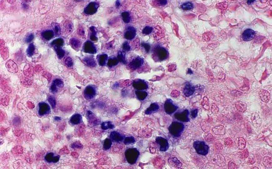 EB病毒是什么病毒？